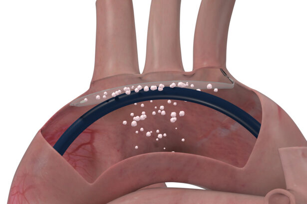 The ProtEmbo Cerebral Embolic Protection system in the Aortic Arch (Graphic: Business Wire)The ProtEmbo Cerebral Embolic Protection system in the Aortic Arch (Graphic: Business Wire)The ProtEmbo Cerebral Embolic Protection system in the Aortic Arch (Graphic: Business Wire)The ProtEmbo Cerebral Embolic Protection system in the Aortic Arch (Graphic: Business Wire)The ProtEmbo Cerebral Embolic Protection system in the Aortic Arch (Graphic: Business Wire)The ProtEmbo Cerebral Embolic Protection system in the Aortic Arch (Graphic: Business Wire)The ProtEmbo Cerebral Embolic Protection system in the Aortic Arch (Graphic: Business Wire)